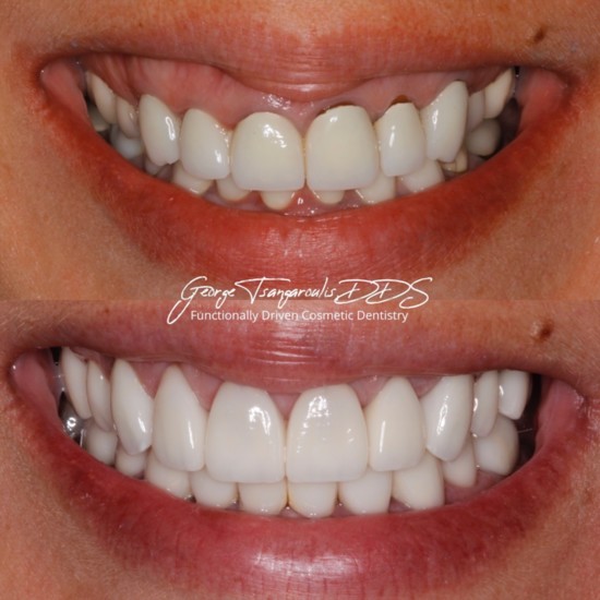 Before and After porcelain veneers