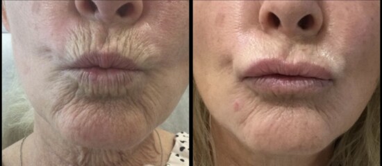 Before and After: Lip Flip And chin neuromodulator treatment 