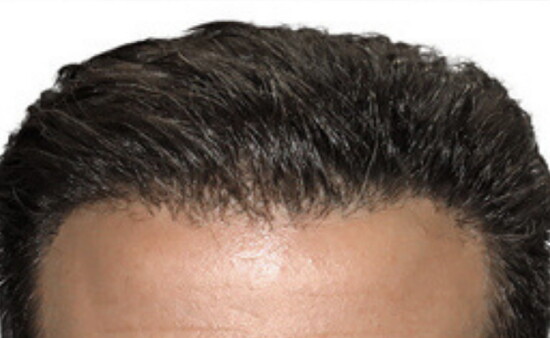 10 Months Post-ARTAS