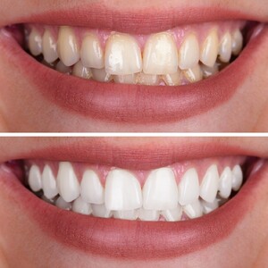 teeth%20whitening%20002-300?v=1