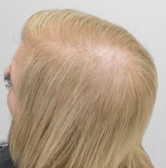 Before - Hairdreams Microlines Hair topper extensions