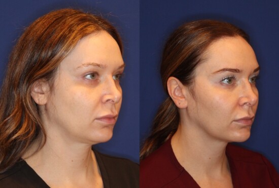 EMFACE Results Courtesy of Dr. Jennifer Levine, NYC Facial Plastic Surgeon