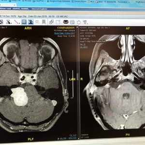 before%20and%20after%2099%20of%20the%20tumor%20removed-300?v=1