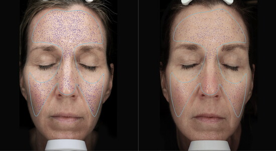VISIA Skin Analysis used to identify and treat skin conditions