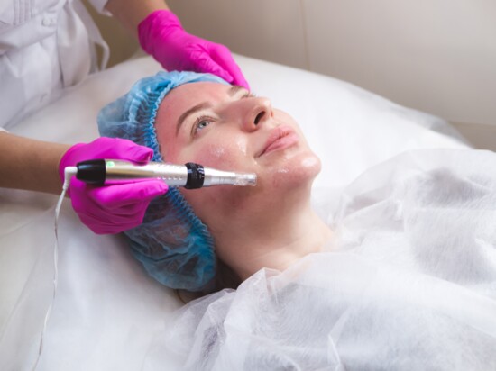 Microneedling 