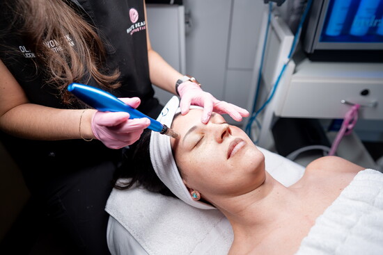 Microneedling