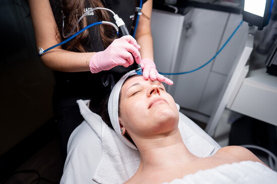 Microneedling
