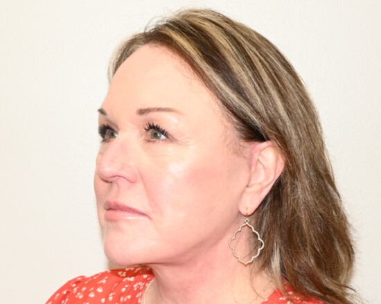 Two months post surgery