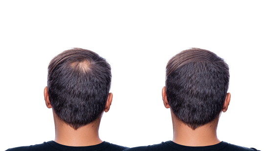 Before & After