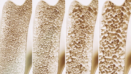 Bone health deterioration - healthy to severe osteoporosis