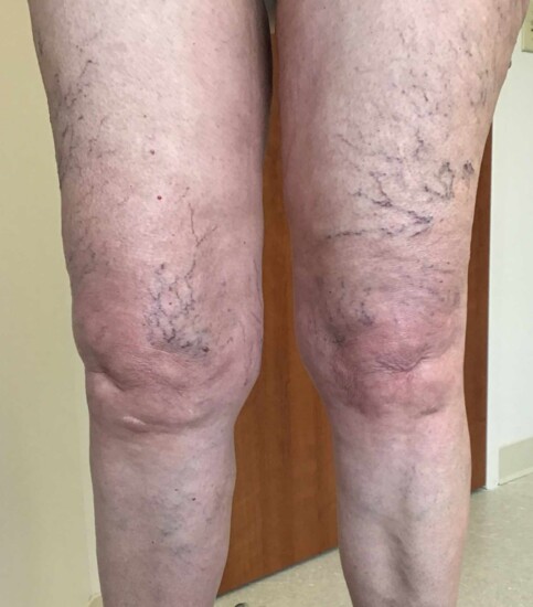 Before sclerotherapy