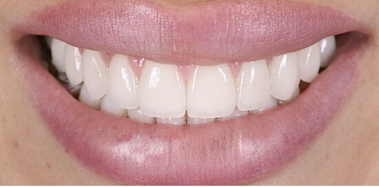 A finished set of Apa porcelain veneers