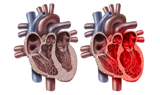 With Broken-Heart Syndrome part of the heart enlarges and doesn’t pump as effectively.