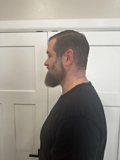 9 months post surgery