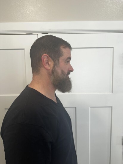 9 months post surgery