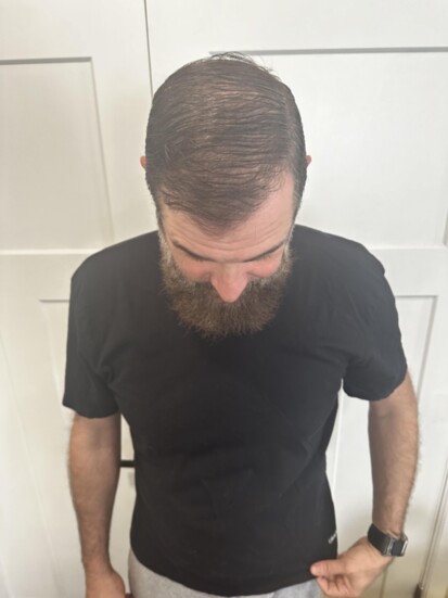 9 months post surgery