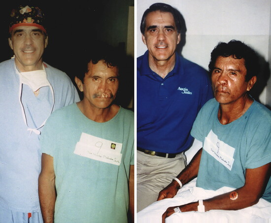 Dr. Bob Clement before and after performing cleft lip and palate surgery.