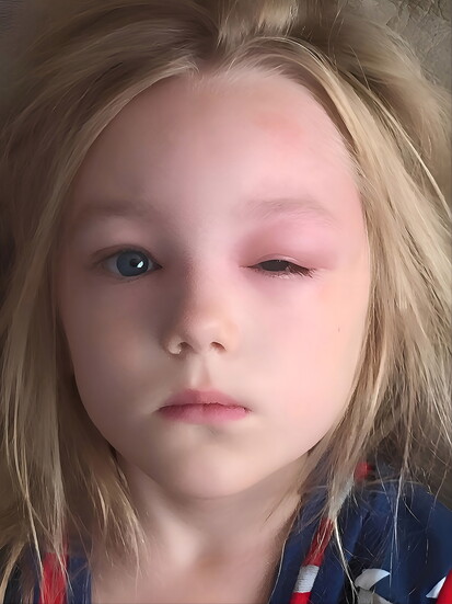 Diana Shea's daughter experienced severe swelling from mosquito bites, a challenge that ultimately inspired the creation of Buzz Blocker.