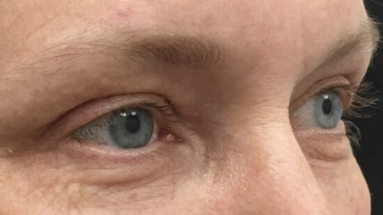 After an upper blepharoplasty and brow reconstruction.