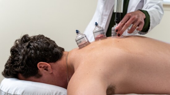 Cupping at American Acupuncture Center