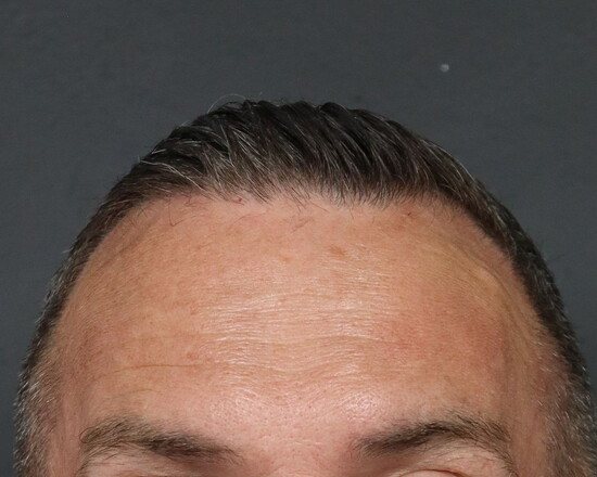 After-Treated with Botox