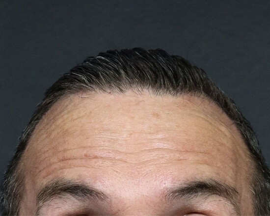 Before-Untreated