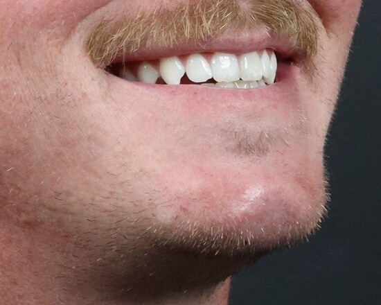 After-Treated with Chin Filler