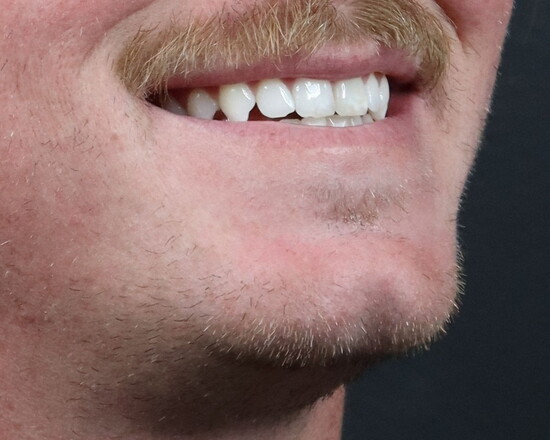 Before-Untreated
