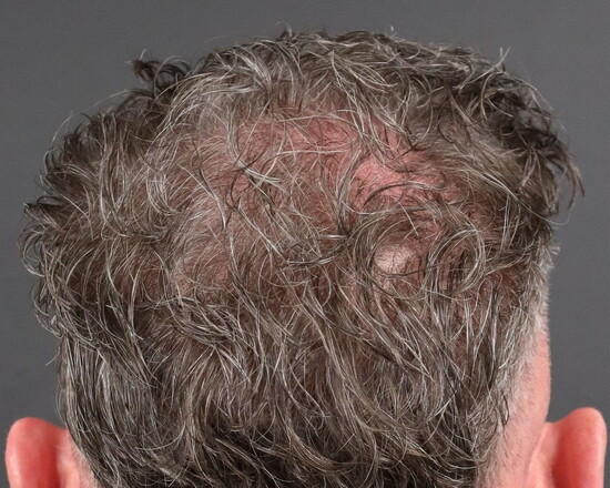 After-Treated with Hair Restoration