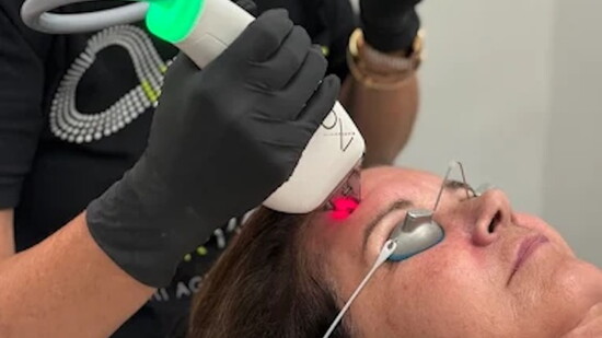 Ashley using Moxi to correct sun damage and aging.