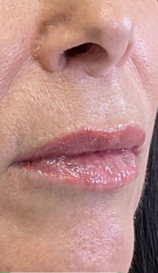 After: Achieved a subtle enhancement with Juvéderm Volbella to smooth out lipstick lines and correct those small divots for a fuller, more defined look!