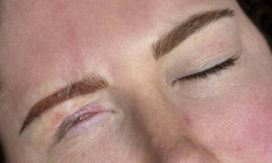 Patient Brows After